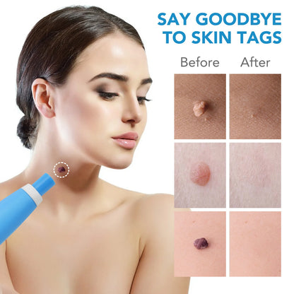 Skin Tag Removal Pen