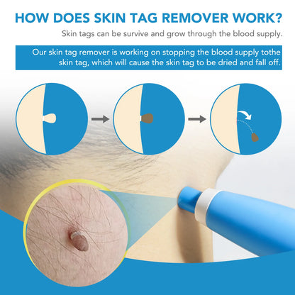 Skin Tag Removal Pen