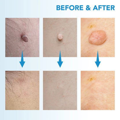 Skin Tag Removal Pen